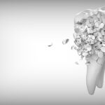 Erste Hilfe und Maßnahmen bei einem abgebrochenen Zahn